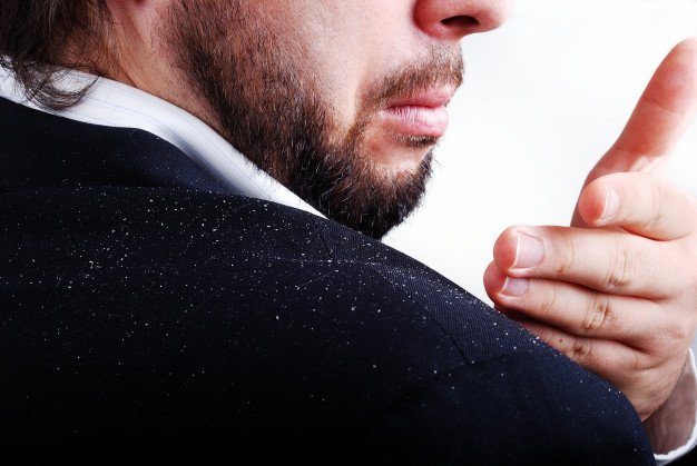You are currently viewing Permanent Ayurvedic Treatment and Home Remedies for Dandruff in Hyderabad and Vizag India